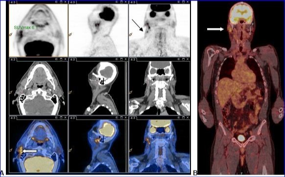 A and B: PET-CT with 18F-FDG injection of iodinated contrast showed: A.Intense and diffuse hyper metabolism at the surgical site in the right parotid (large white arrow) and discretely hypermetabolic lymph nodes in the ipsilateral lymph nodes areas II and III (thin black arrow). B. Lack of morphological or metabolic arguments for primary or secondary manifestation of malignant melanoma of the others structures examined.
