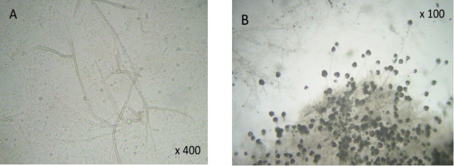 ( A) filamentous fungal infection of Aspergillus type. (B) Culture and staining techniques categorized the specie as Aspergillus fumigatus