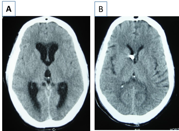 cerebral CT scan with axial view showing acute hydrocephalus (A) and control after external ventricular drainage (B)