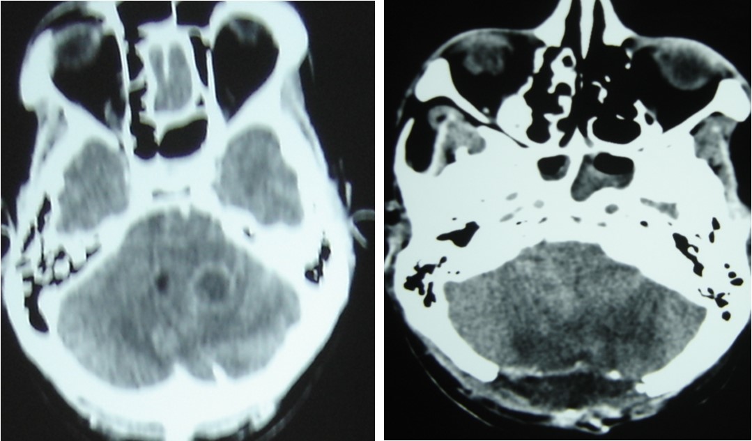 cerebral CT scan pre operative (A) and post operative (B) after posterior fossa surgery with total removal or abscesses