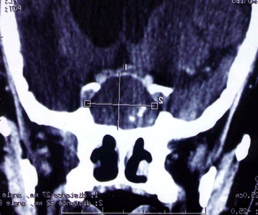 CT scan showing a hypodense mass enlarging the sphenoid sinus and sellar region with calcification like images and bone erosion of the sellar floor