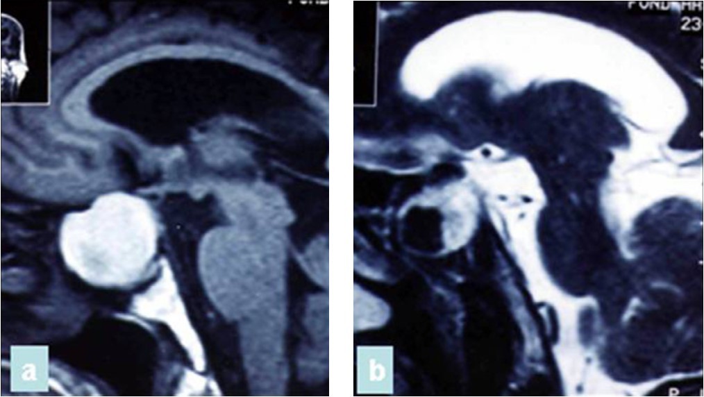 (a) Sagittal T1-weighted MRI showing a well circumscribed hyperintense process in the sphenoidal sinus and sellar region; (b) parasagittal T2-weighted MRI showing a regular hypointense zone into the hyperintense process which is specific to aspergillus infection and corresponds to iron accumulation