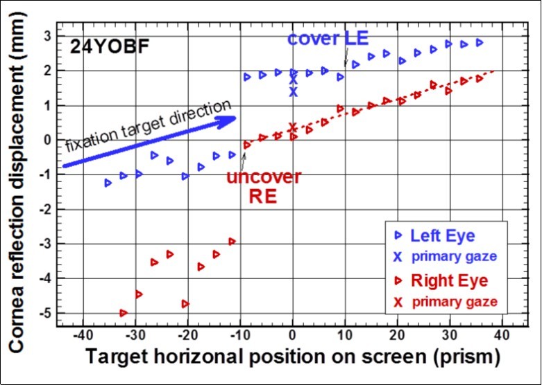 Eye alignment test result of a left eso-tropia (LET) case. Upper image is the infrared image at primary gaze. Lower image is the eye tracking data.