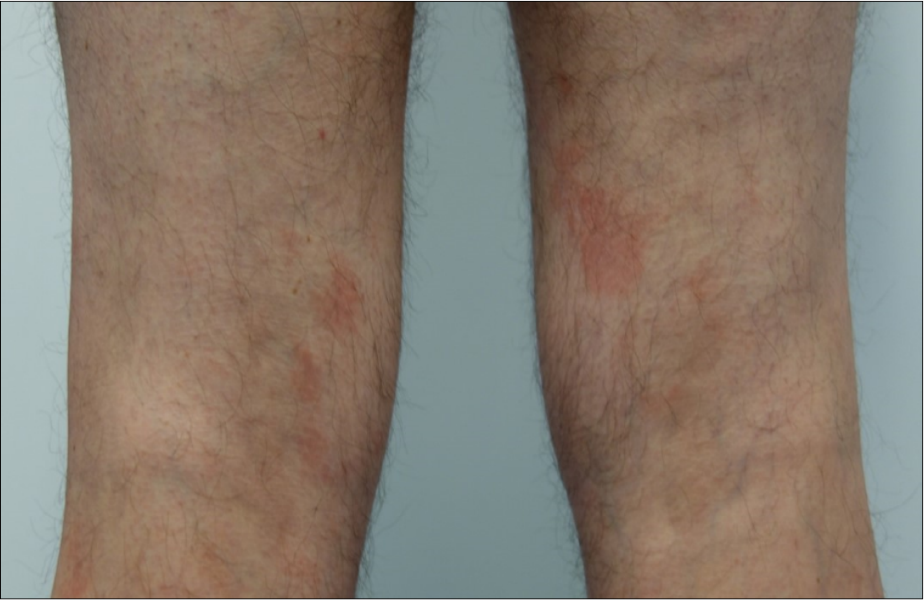 Red-brown patches on the lower limbs.