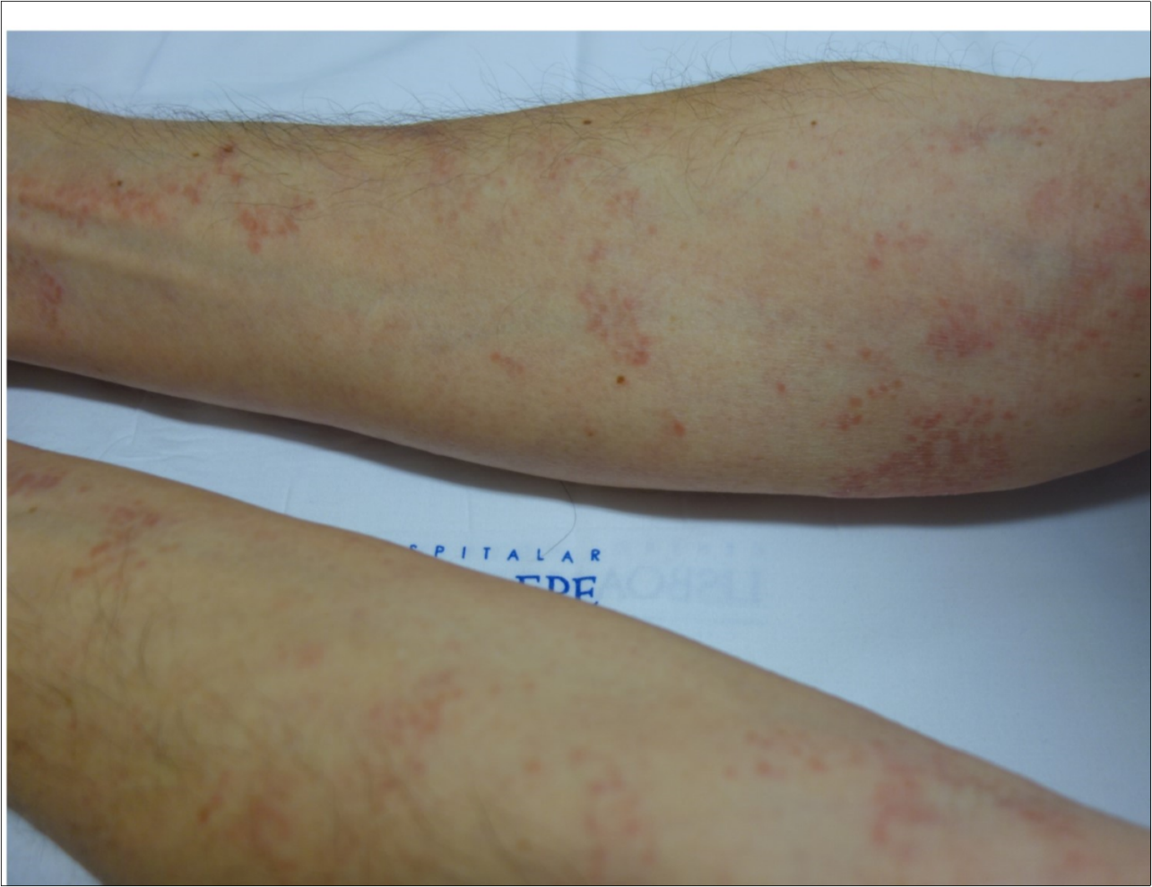 Red-brown patches and papules on the upper limbs.