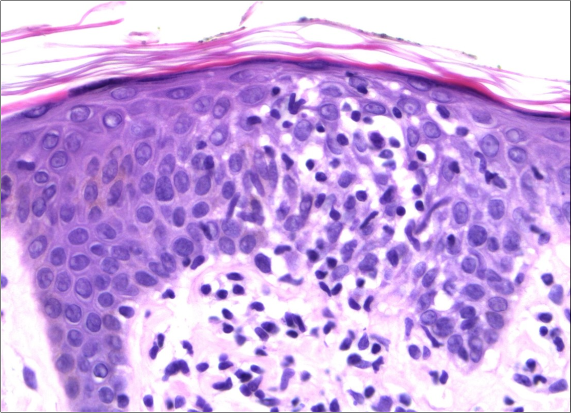 The skin biopsy revealed a dense pleomorphic lymphoid infiltrate in the superficial dermis and epidermotropism (HEx40)