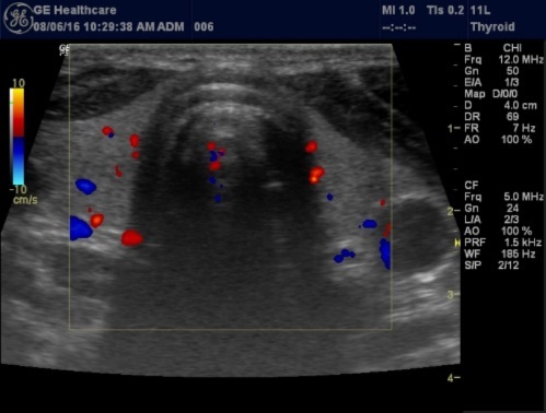 Blood flow pattern in normal thyroid gland