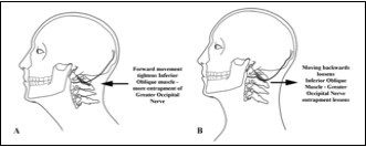 Ergonomic issues of head position on occipital nerve entrapment (Images courtesy of Epimed International®, with permission)