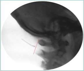 Lateral fluoroscopic image showing the needle in the suboccipital space; red shows the level of the spinous processes (red line). Image Courtesy of Gabor Racz, MD