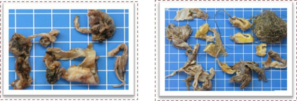 a, Gross findings of the endometrioma with brown internal surface. b, Mature cystic teratoma with fat tissue and hair.