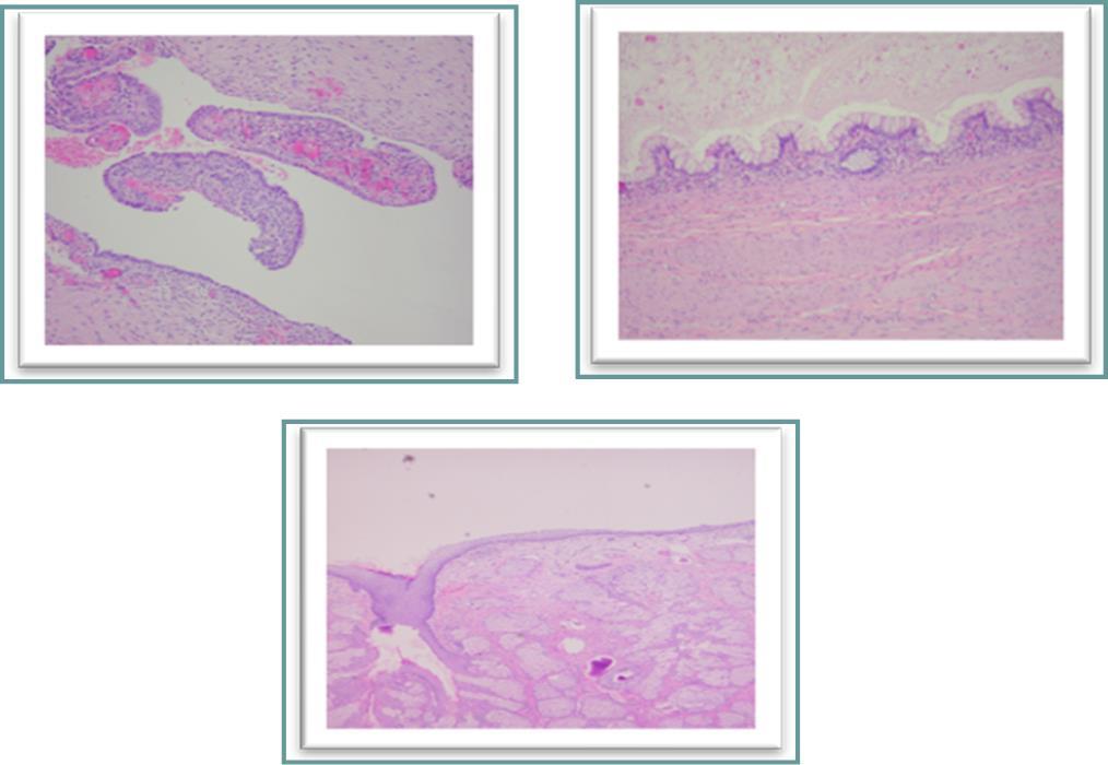 Histological examination. a, cyst lined by endometrial epithelium overcoming its endometrial stroma corresponding to an endometriosis cyst. b, a portion of the cystic mature teratoma lined with intestinal-type mucosa. c, skin surface-like structure with many sebaceous glands found on another part of the cyst.