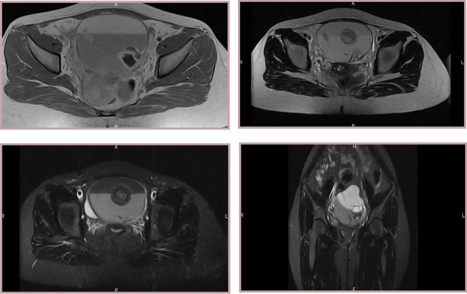 Two lesions within cystic component measuring 6 x 7 x 8 cm. MRI reveals a large and well-defined encapsulated tumour. Two solid components with an intermediate signal in T2 and T1 with a moderate contrast enhancement on T1 weighted.