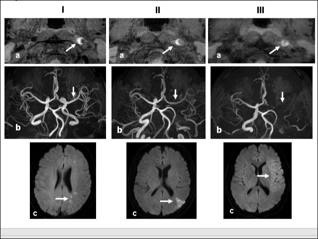 Time course Columns I, II, and III are images obtained 1, 2, and 3 weeks, respectively, after the start of dissection of the cervical segment of the internal carotid artery. Ia, IIa, IIIa.T1 VISTA images of the same segment shown in Fig. 1C. The dark area reflective of the low void progresses to hyperintensity by week 3. IIIa shows complete occlusion of the true lumen by the intramural hematoma (arrow ). Ib, IIb, IIIb. TOF-MRA images of the intracranial arteries. (a) The left MCA is supplied via antegrade flow from the left carotid artery (arrow). (b) Flow from the left carotid artery disappeared from the ICA bifurcation to the top of the ICA. Blood supply to the left MCA derives from the circle of Willis via the anterior- or the posterior communicating artery (arrows). By week 3, flow to the left MCA, even via the left A1 segment of the anterior cerebral artery had disappeared completely. Ic, IIc, IIIc. Diffusion-weighted images at the basal ganglia level. Week 1: a few hyperintense areas are visualized in the border zone of the left cerebrum (arrow). Week 2: Note the hyperintensity area in the watershed zone between the left ACA and the MCA, and between he MCA and the PCA (arrow). The image acquired on week 3 shows a diffuse hyperintensity area in the left MCA territory (arrow).