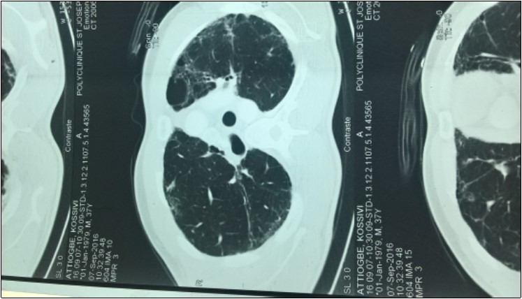 The mediastinum scan