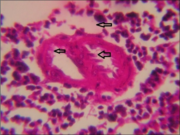 spleen (dead cattle less than 1 year old) showed severe depletion of lymphocytes with necrosis of endothelial lining or splenic arterioles (arrows). (Hematoxylin and fuchsin X 60)