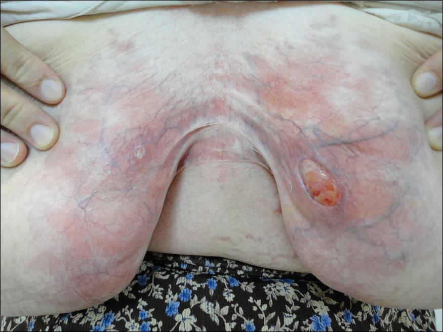 There were erythema, severe cutaneous atrophy and widespread vascular ectasias located all over the intermamarian region and two punched out ulcers were present on the medial sides of her breasts