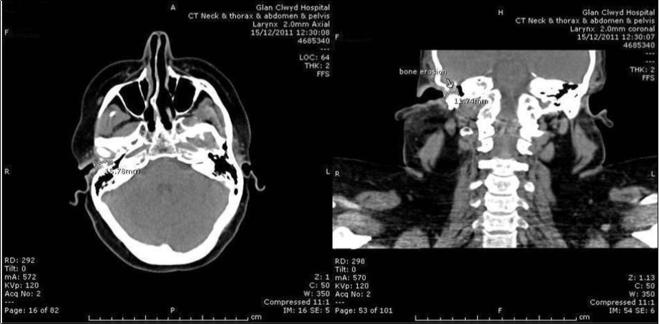 Coronal CT head showing soft tissue occluding right EAC; bony destruction of the roof.
