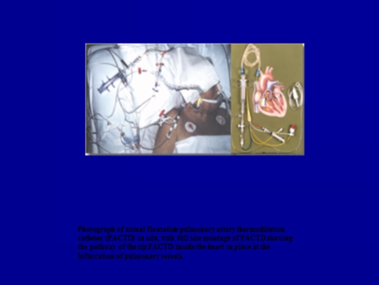 One of the Current Highly Invasive Haemodynamic Right Heart Catheters In -Situ Copyright Medics Limited