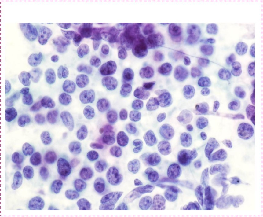 Positive, Non-Hodgkin lymphoma (Papanicolaou stain 50x).