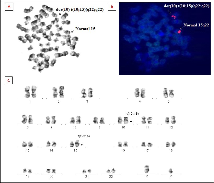 (A) Image of a GTG-banded bone marrow metaphase before FISH analysis. (B) Bone marrow metaphase FISH analysis using a LSI probe (red), revealing localization of one red signal on the derivative chromosome 10q22 and other on the normal 15 chromosome (15q22). (C) Representative karyogram of bone marrow cell showing novel translocations t(10;15)(q22;q22).