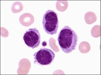 HCL: inconspicuous nucleoli, open-ended chromatic and surface protrusions(26).