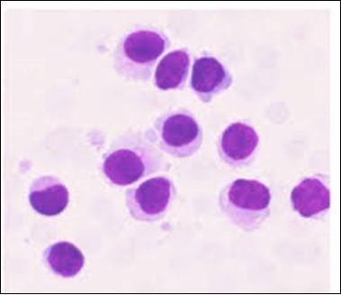 HCL: hairy cells with broad and fine projections of the cytoplasm(28).