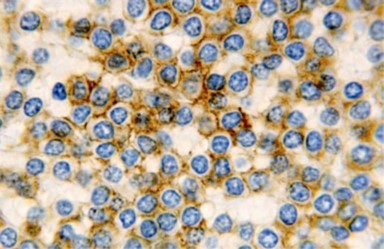 HCL: hairy cells immune reactive for CD 11c(24).