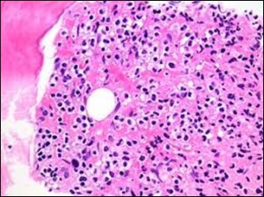HCL: hairy cells with projecting cytoplasm abutting bony trabaculae(18).