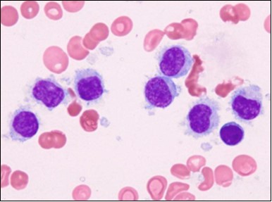 HCL: blebs on the cellular surface with fine nuclear chromatin(23).