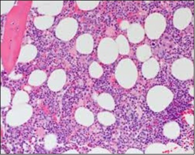 HCL: widely disseminated hairy cells within the bone marrow trabaculae(24).
