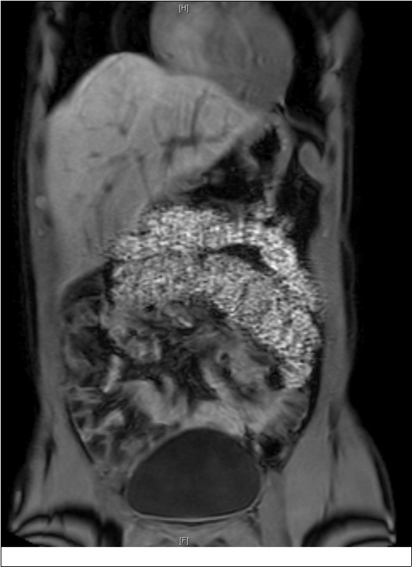 MRI showing non rotation