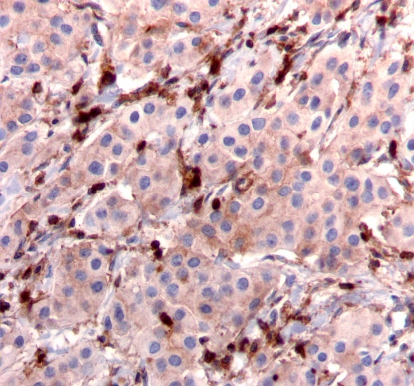 Diffuse cytoplasmic staining pattern for IRS-2. (IRS-2 immunohistochemical stain, 200x magnification)