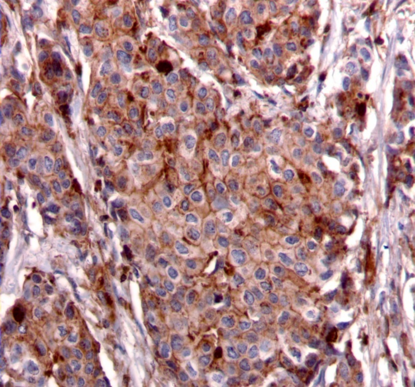 Membranous staining pattern for IRS-2. (IRS-2 immunohistochemical stain, 200x magnification)