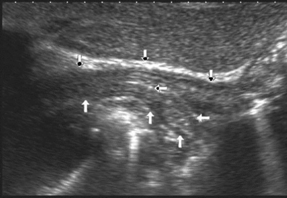 Ultrasonography of the abdominal esophagus (vertical arrows). Horizontal arrow shows mucosa of the esophagus