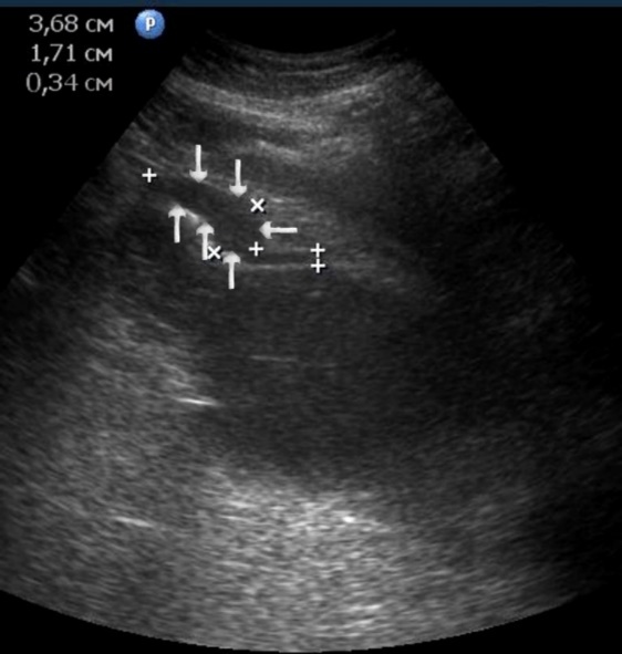 The gastric carcinoma of diffuse infiltrative form. An area with a local thickening up to 1,7 cm, a length of 3,68 cm, is visualized on the anterior wall of the antrum (arrows). The thickening of the normal stomach wall is 0,34 cm.