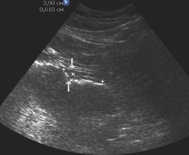 Gastric carcinomas of ulcerating infiltrating forms in the anterior wall of the stomach body of stage T3.