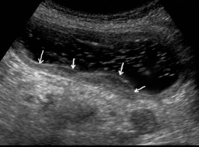 Gastric carcinomas of diffuse infiltrative form in the posterior wall of the stomach body of stage T3. The tumor is manifested by diffuse thickening of the muscle layer, a smooth contour, discontinuous mucosal image without ulceration and involvement of the serous membrane in the process. An enlarged, altered lymph node of low echogenicity, round shape, without differentiation of the peripheral and central part, is visualized behind the stomach.
