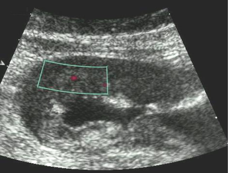 Distal gastric carcinomas of diffuse infiltrative form of T4 stage. Despite the large size of the tumor the vascularization is manifested in the form of single point color vascular signals.