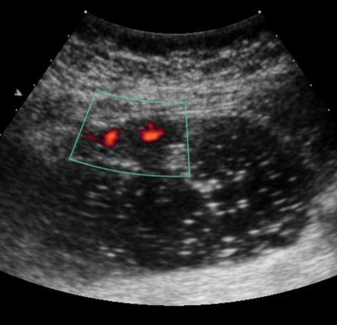 Gastric carcinomas of infiltrative ulcerative form of Ts stage. Despite the small size of the tumor the vascularization is manifested in the form of wide color areas inside the tumor.