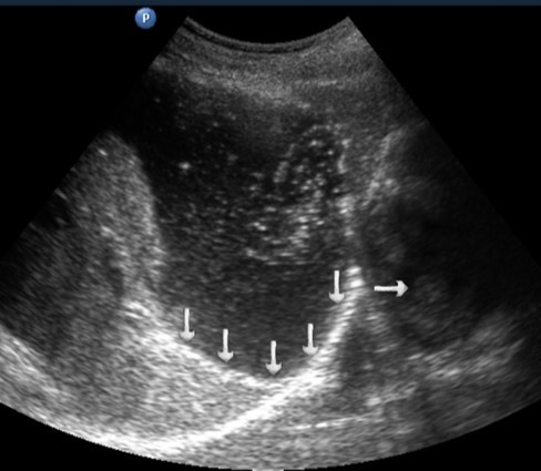 Ultrasonography of the stomach. Vertical arrows show the fundus of the stomach, horizontal arrow – the papillary muscle of the left ventricle.