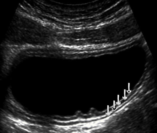 Ultrasonography of the stomach body. The arrows show all layers of the stomach wall in the transverse section