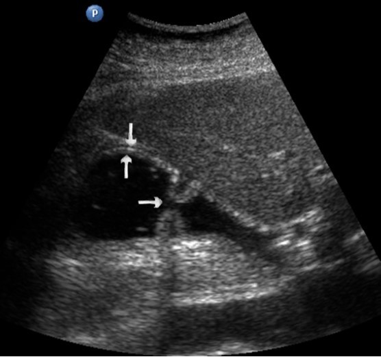 Ultrasonography of the stomach. The vertical arrows show the anterior wall of the antrum; the horizontal arrows – pyloric, which is not fully open.