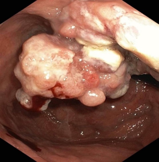 Endoscopic picture of gastric carcinoma for T3 stage. The tumor is visualized as a formation on a wide base above the gastric mucosa of a non-uniform structure, an irregular surface (arrows).