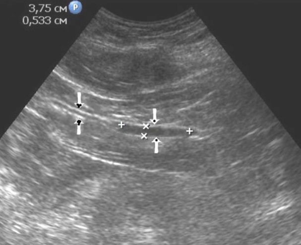 The gastric carcinoma of diffuse form. An area with a local thickening up to 5 mm, a length of about 37 mm, is visualized on the anterior wall of the stomach body. The left arrows show the differentiated intact wall layers, the right arrows – local thickening hypoechoic of the anterior wall. Mucous, muscular and serous membranes are differentiated.