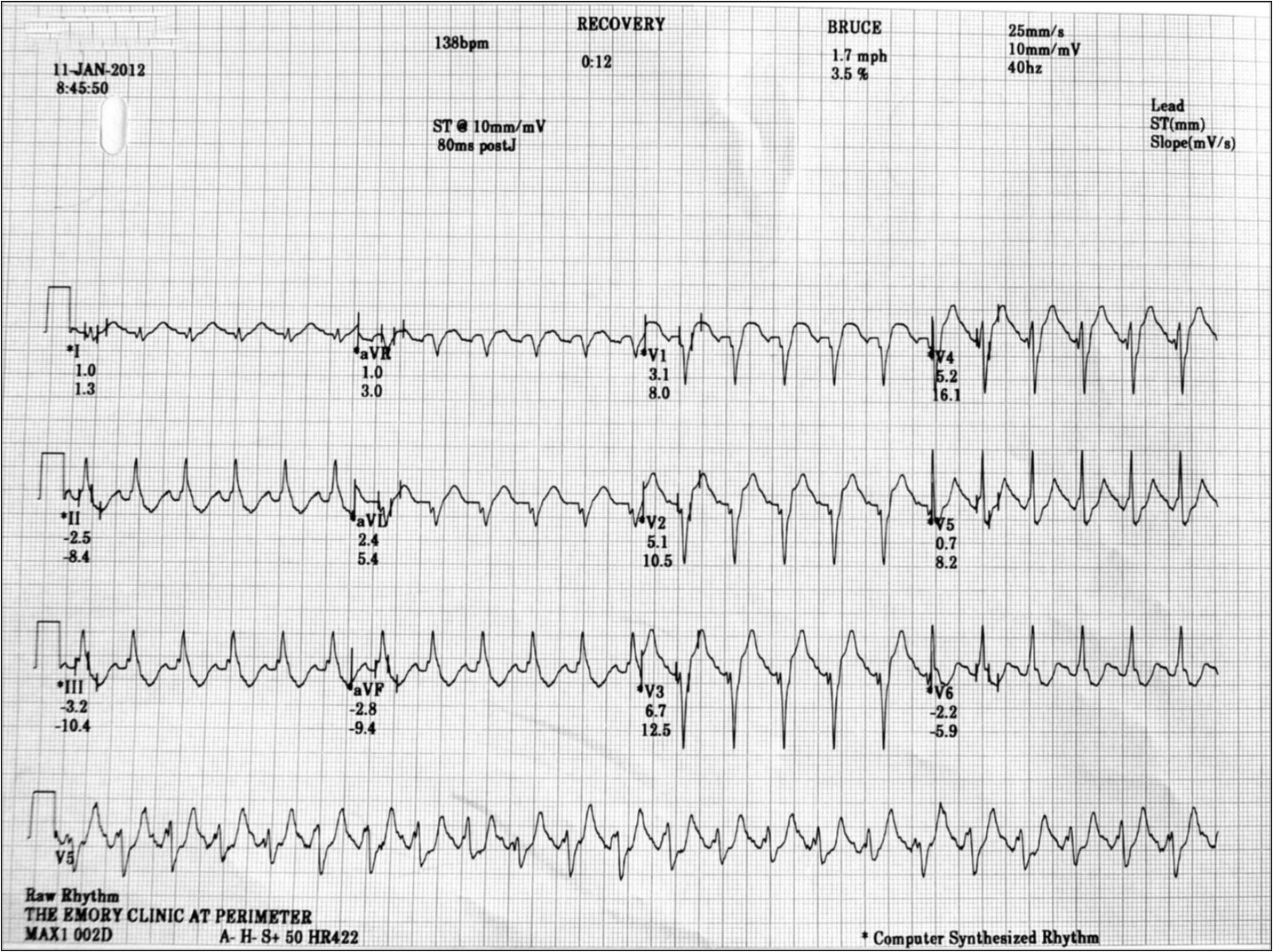 LBBB appeared at a heart rate of 138 bpm, during the initial phase of the recovery period of the stress test.