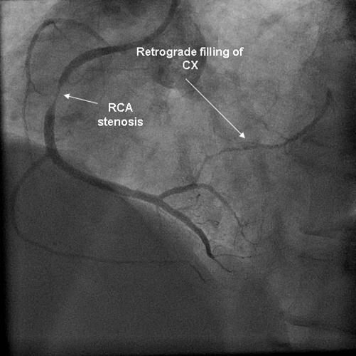 Injection into the RCA in the first angiogram, with retrograde filling of CX.