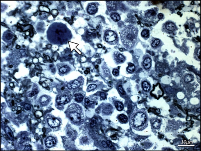 Additional examinations of post-mortem biopsy material - light microscopy. Subcortical white matter from a patient with PML (routine blue-toluidine staining). Enlarged naked hyperchromatic nucleus of oligodendroglial cell infected with the polyomavirus (arrow) is demonstrated.